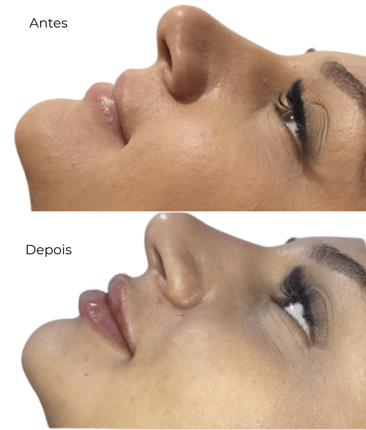 Antes e Depois - Preenchimento Labial e Harmonização Donna Belíssima