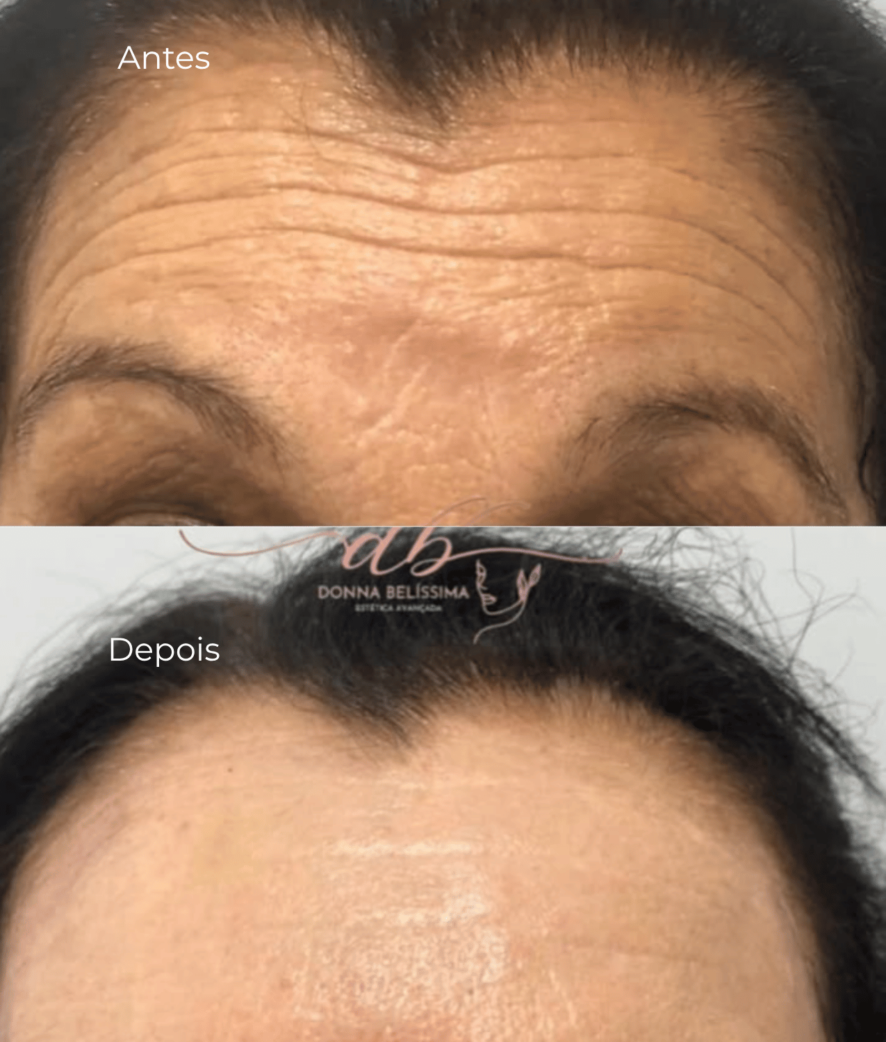 Antes e Depois - Rejuvenescimento Facial Donna Belíssima